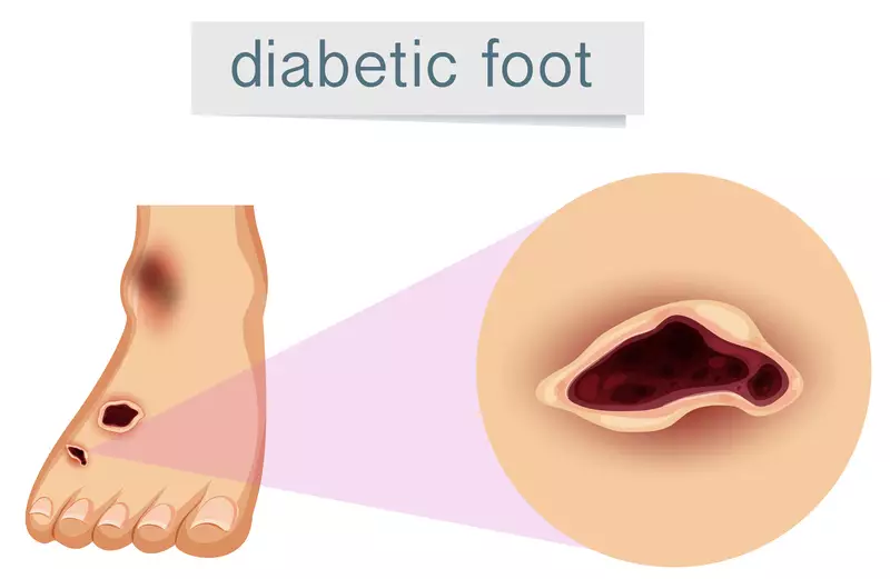 Stepping Ahead: Diagnosing Diabetes Foot Ulcers for Timely Treatment and Prevention