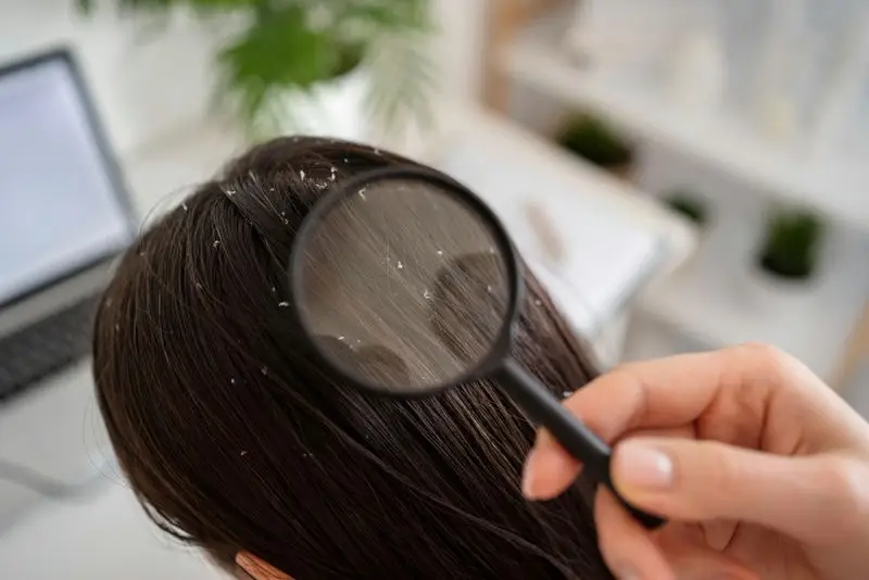 Shampoo or No Shampoo for Dandruff Issues