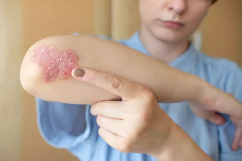 Taking Charge of Psoriasis: Simple Ways to Handle Inflammation