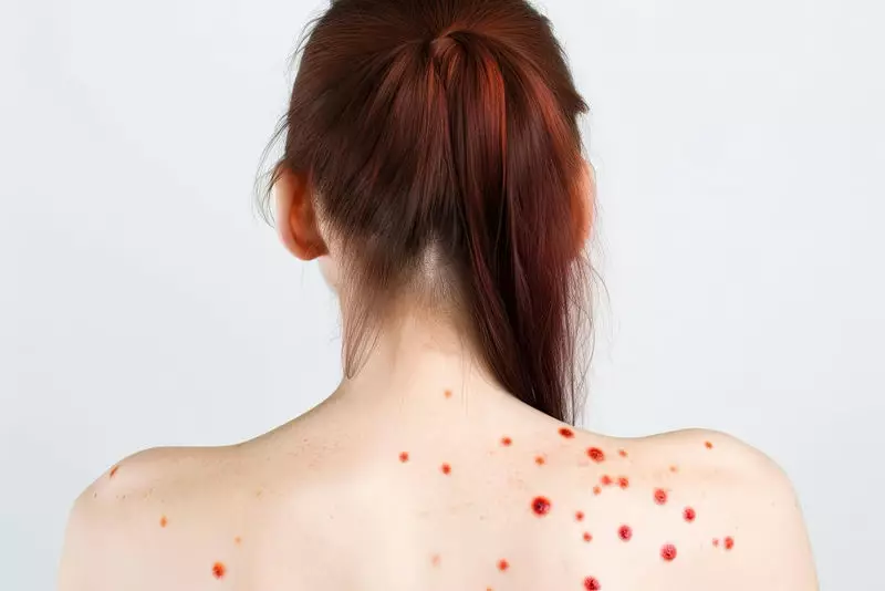 Why Do We Get Hives? Learn Simple Signs and How to Recognize Them