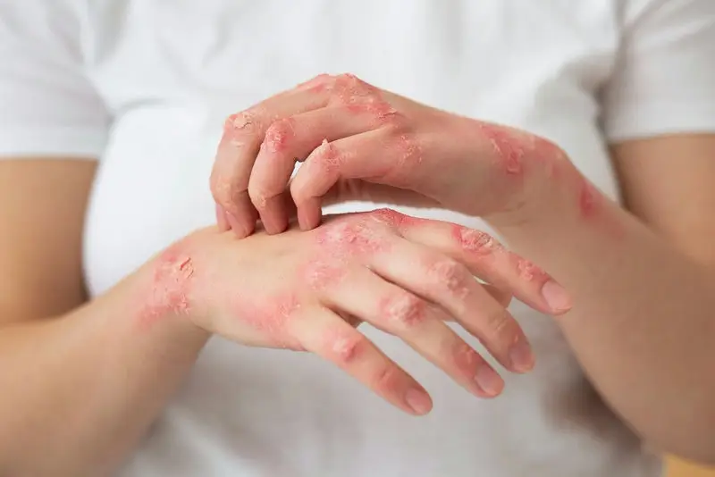 Everything You Need to Know About Eczema? Symptoms, Causes, Treatment