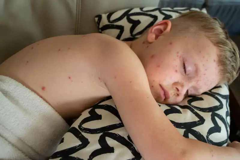How Skin Problems Like Eczema Can Mess with Your Sleep