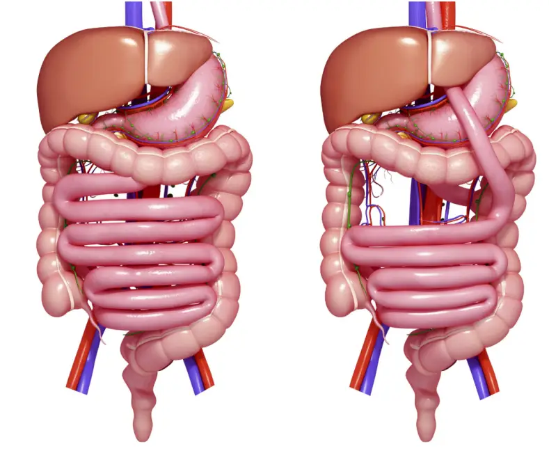 gastric bypass? What are the benefits of a Gastric bypass?