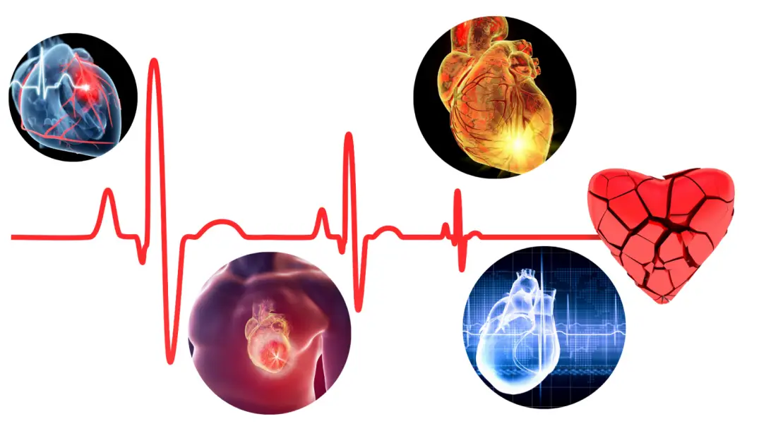 What is a Massive Heart Attack?