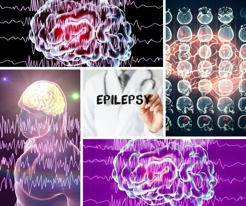 Managing Epilepsy