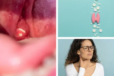 Removing Tonsil Stones At Home: Home remedies  And Safety Precautions