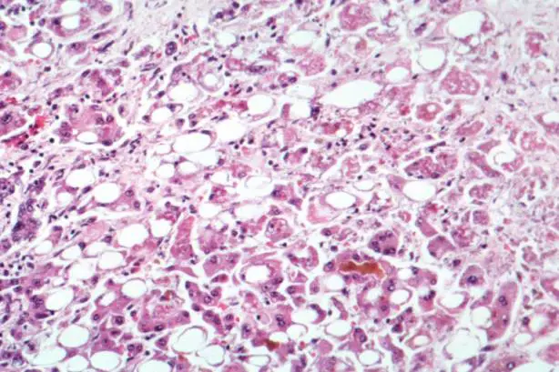 Alcoholic liver disease alcohol that damages the liver