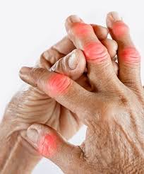 JAANCH RHEUMATOID ARTHRITIS PACKAGE
